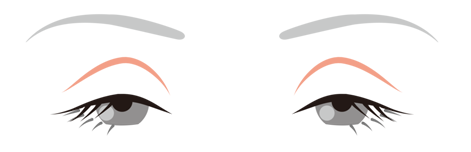 眼瞼下垂の状態